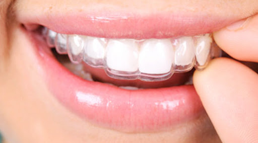 Apparecchio per i denti